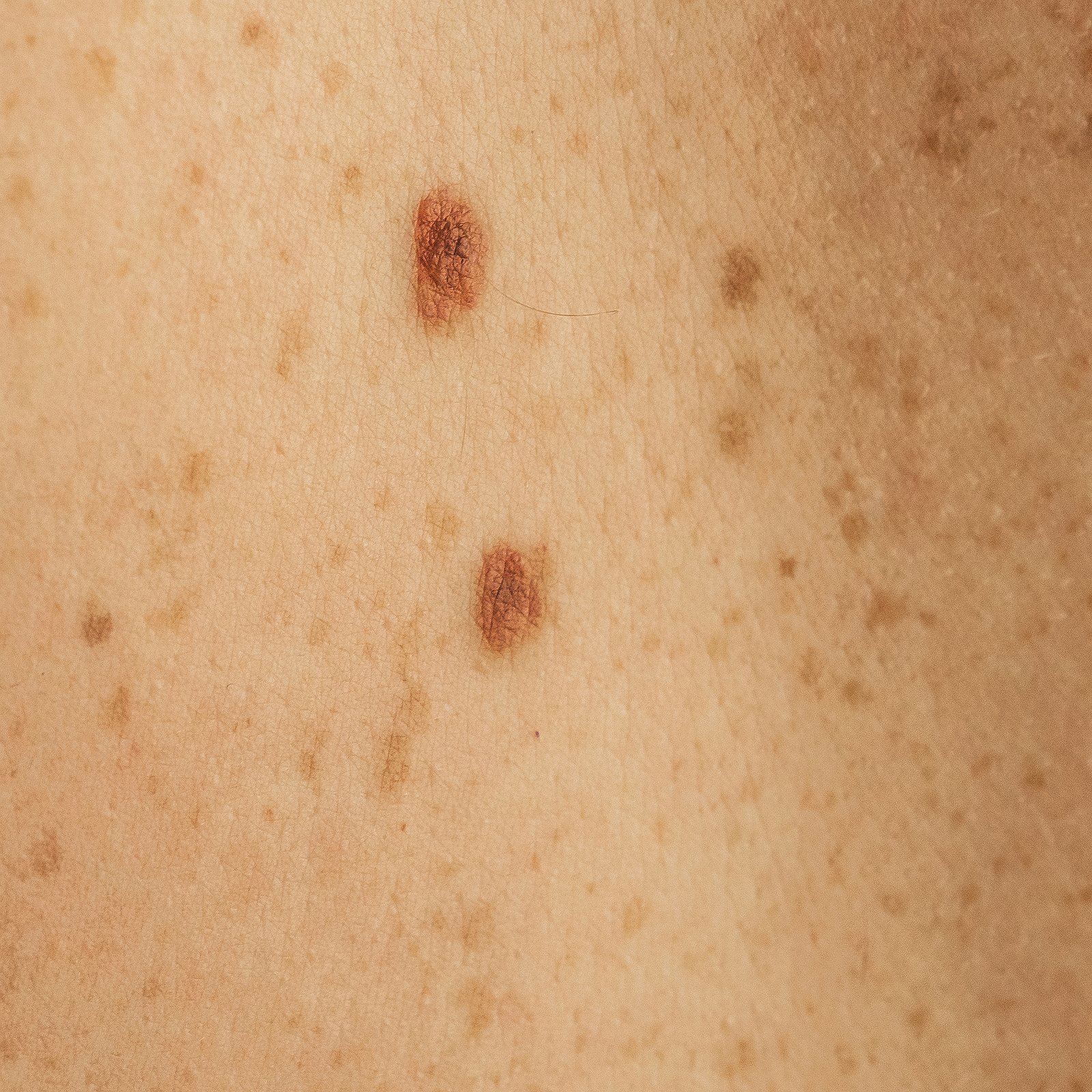 Real-Time Dermatology Classification with AINA, the LabCobot - SupraWorx Workbench, Powered by NVIDIA Clara AGX